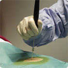 Application of C3 CryoSystem